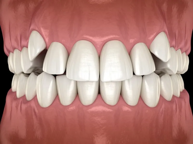 Impaction treatment at Apex Dental Care Bhadrak
