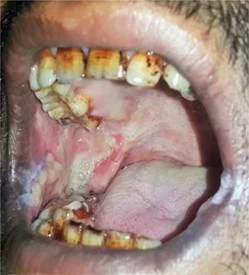 Oral Submucous fibrosis (OSMF) at Apex Dental Care Bhadrak