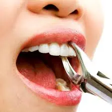 Pain Less Extraction at Apex Dental Care Bhadrak