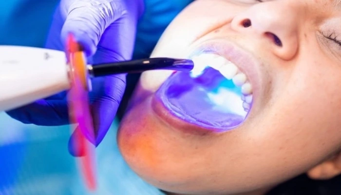Restoration (Laser Filling) at Apex Dental Care Bhadrak