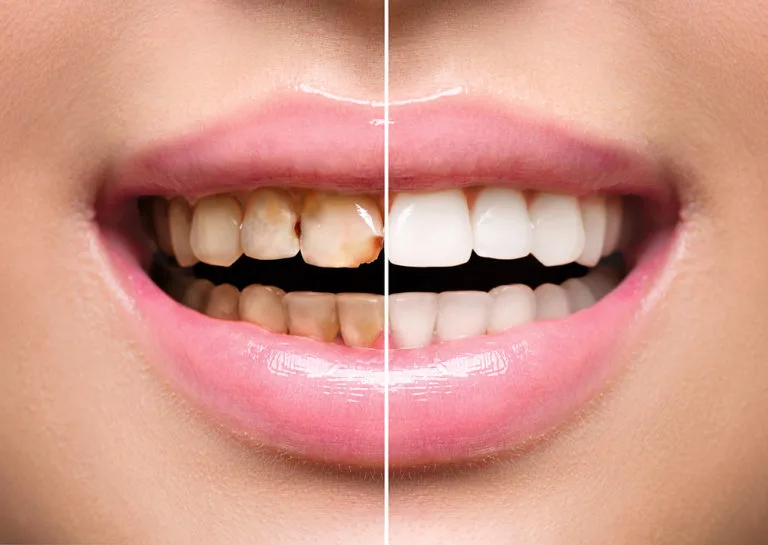 Scaling and Polishing at Apex Dental Care Bhadrak